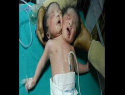 Hindistan'da çift başlı bebek