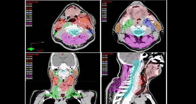 Kanser tedavisinde ’yapay zeka’ başarısı