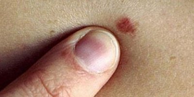 Sedat Özkan:''Kanser hastaları psikolojik destek almalı''