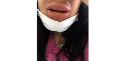 Dudak faciası mağdurları artıyor