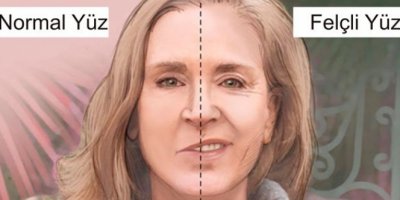 Yüz felci belirtileri, yüz felci nasıl geçer, ne iyi gelir?