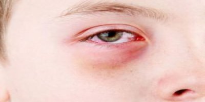 Göz alerjisi astigmata yol açabilir