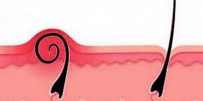 Kıl dönmesi belirtileri, nedenleri ve tedavi yöntemleri