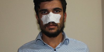 Kavga ettiği kuzeni tarafından burnu koparıldı