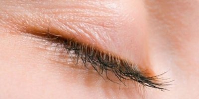 Kirpik iltihabı nedir?