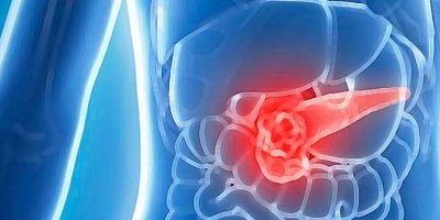 Kanserde doğru bilinen yanlışlar