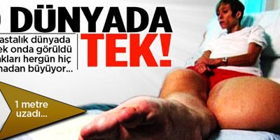 Dünyada Sadece bir kişide görülen hastalık