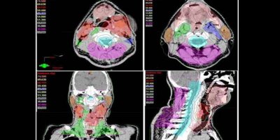 Kanser tedavisinde ’yapay zeka’ başarısı