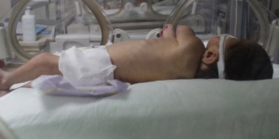 Bebeğin kalçasından ağırlığınca kitle alındı