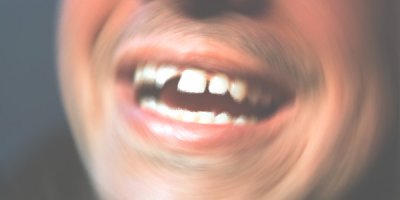 Dişlerdeki kırık problemine dikkat