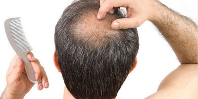 Saç ekimi hakkında merak edilenler