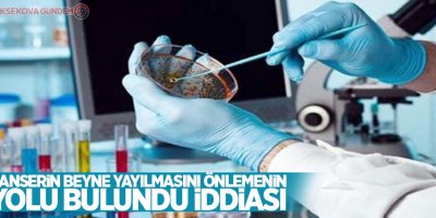Kanserin beyne yayılmasını önlemenin yolu bulundu iddiası